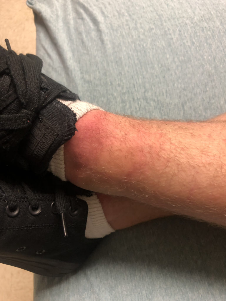 Danny's Anaphylactic Allergic Reaction to Fire Ants 